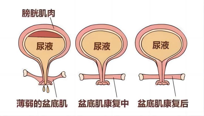 九游首选医疗丨如何有效运用振动提高盆底肌肉激活水平？